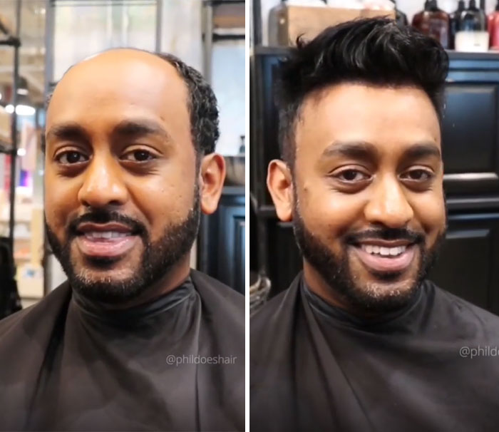 Before-After-Hair-Replacement-Phildoeshair
