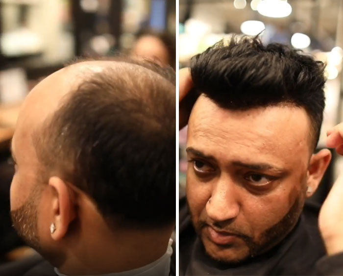Before-After-Hair-Replacement-Phildoeshair
