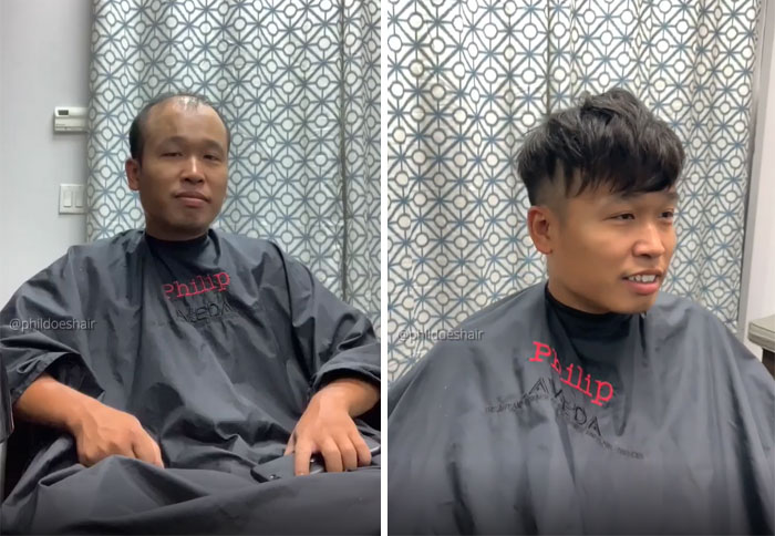 Before-After-Hair-Replacement-Phildoeshair