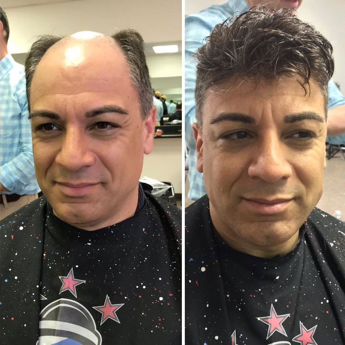 Before-After-Hair-Replacement-Phildoeshair