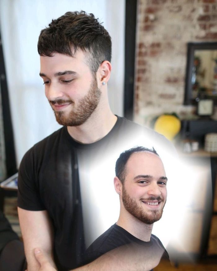 Before-After-Hair-Replacement-Phildoeshair
