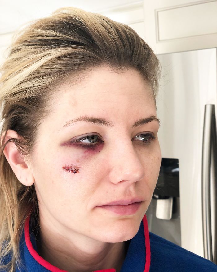 100 Yard Golf Shot Straight To The Face While Watching Sunset In Backyard Of Home On Golf Course