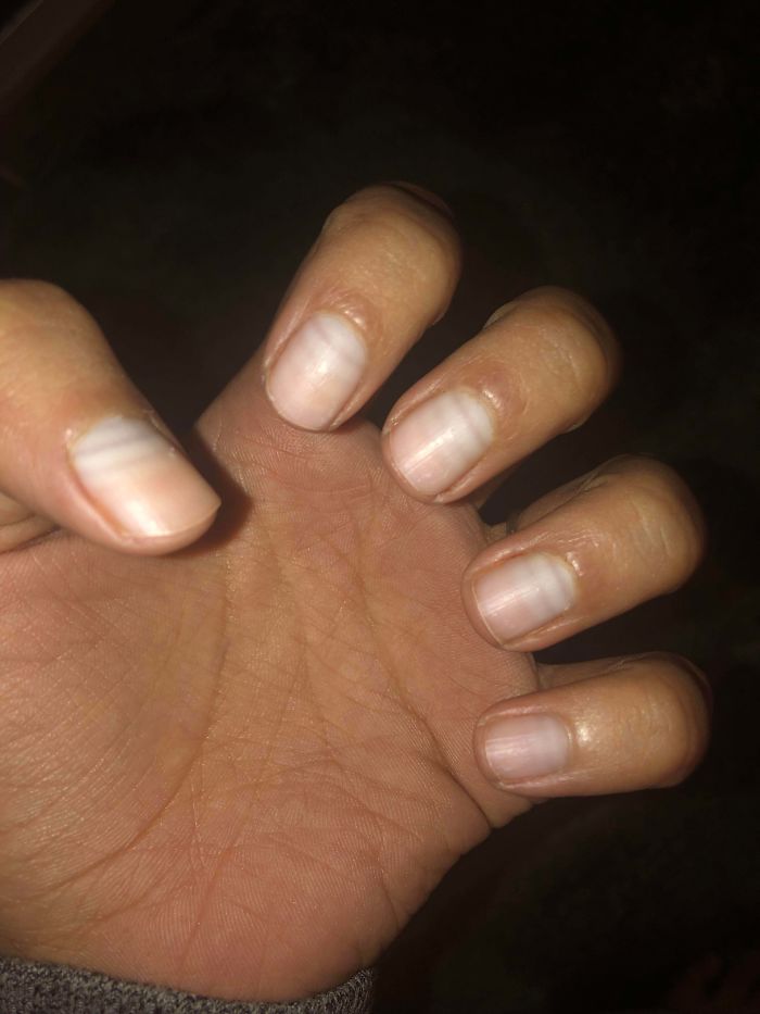 You Can See Where My Nails Stopped And Started Growing Again Between Chemo Cycles