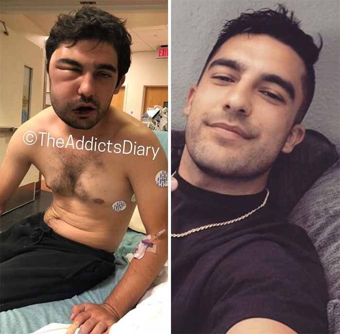 Addicts-Diary-Before-After-Photo