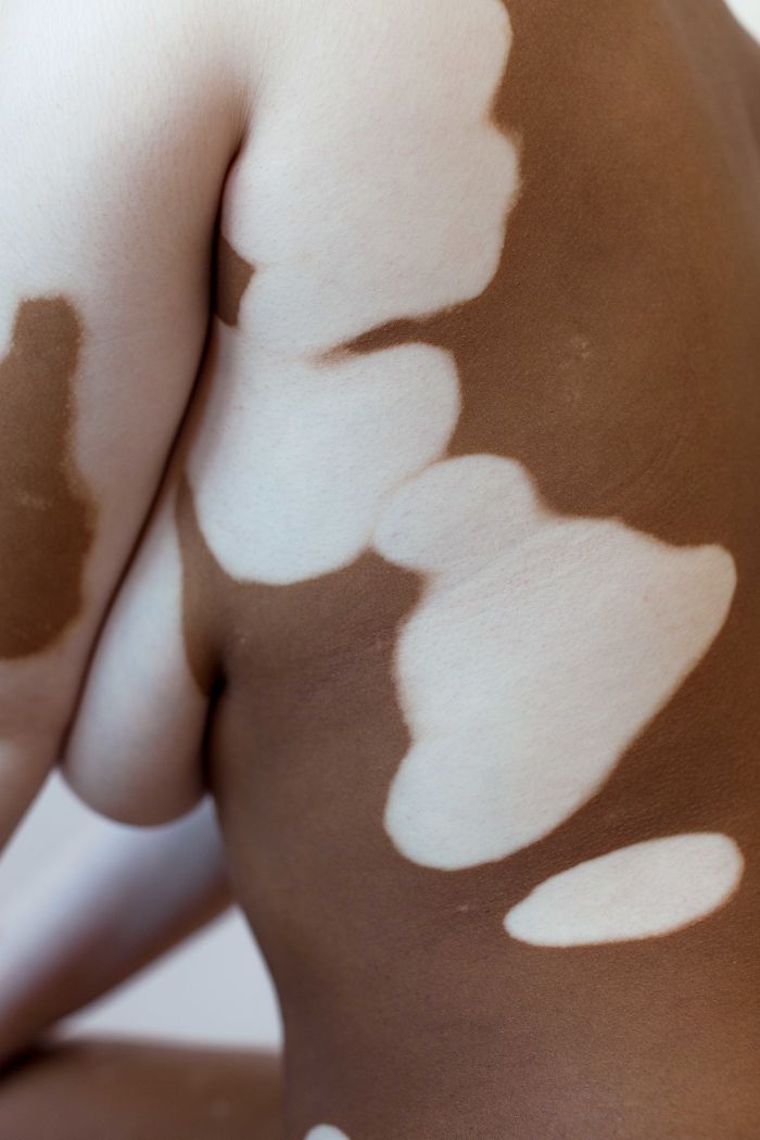 Vitiligo-Beauty-Photography-Elisabeth-Van-Aalderen