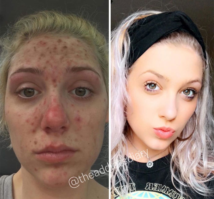 Addicts-Diary-Before-After-Photo
