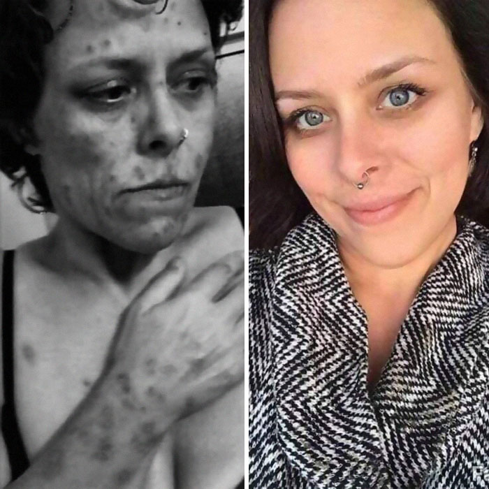 Addicts-Diary-Before-After-Photo