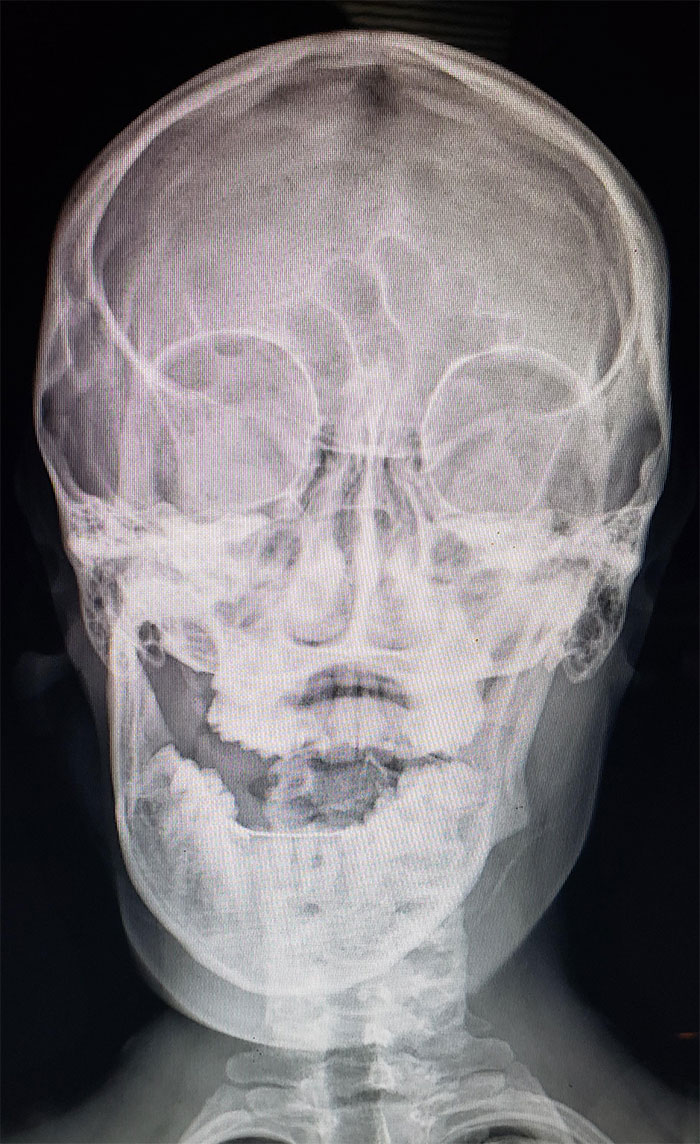 I Dislocated My Jaw. While Eating Cereal