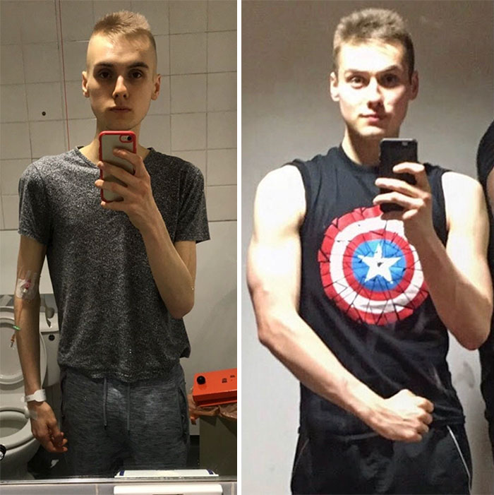People Have To Explain Guys Can Have Anorexia Too After A Before-And-After Pic Leaves Some In Disbelief
