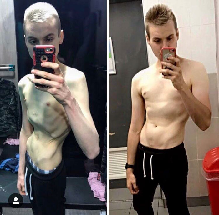 People Have To Explain Guys Can Have Anorexia Too After A Before-And-After Pic Leaves Some In Disbelief People Have To Explain Guys Can Have Anorexia Too After A Before-And-After Pic Leaves Some In Disbelief