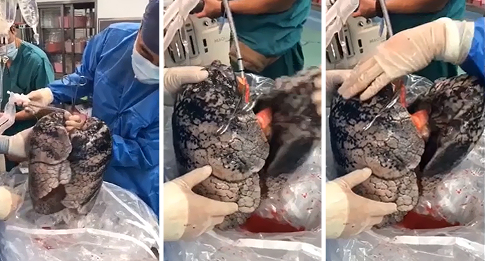 Surgeons Show What The Human Lungs Look Like After 30 Years Of Smoking & It's Shocking Surgeons Show What The Human Lungs Look Like After 30 Years Of Smoking & It's Shocking