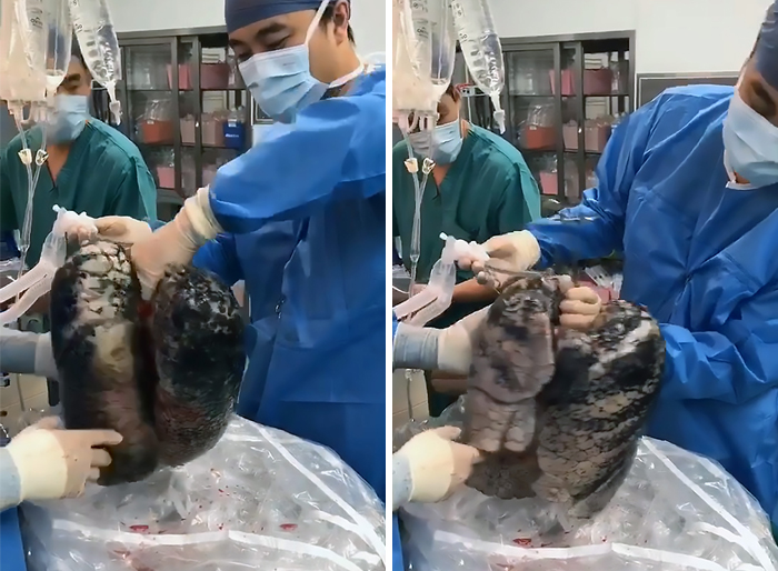 Surgeons Show What The Human Lungs Look Like After 30 Years Of Smoking & It's Shocking Surgeons Show What The Human Lungs Look Like After 30 Years Of Smoking & It's Shocking