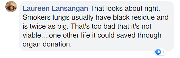 Surgeons Show What The Human Lungs Look Like After 30 Years Of Smoking & It's Shocking