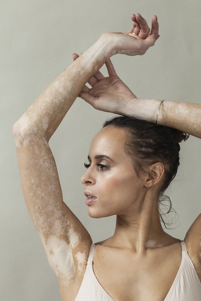 Vitiligo-Beauty-Photography-Elisabeth-Van-Aalderen