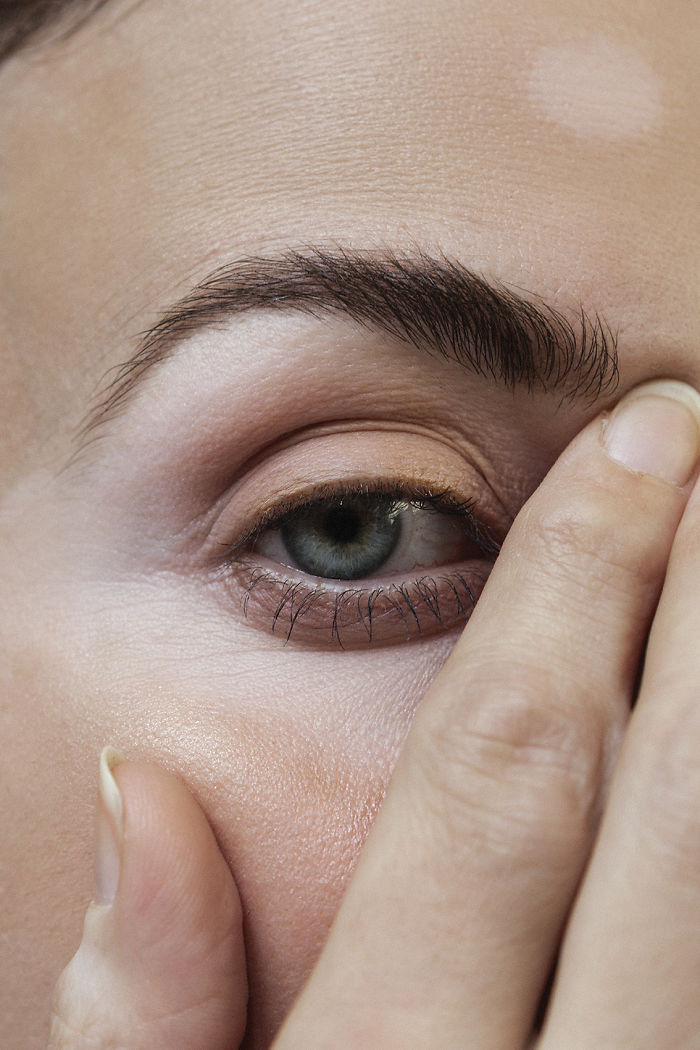 Vitiligo-Beauty-Photography-Elisabeth-Van-Aalderen