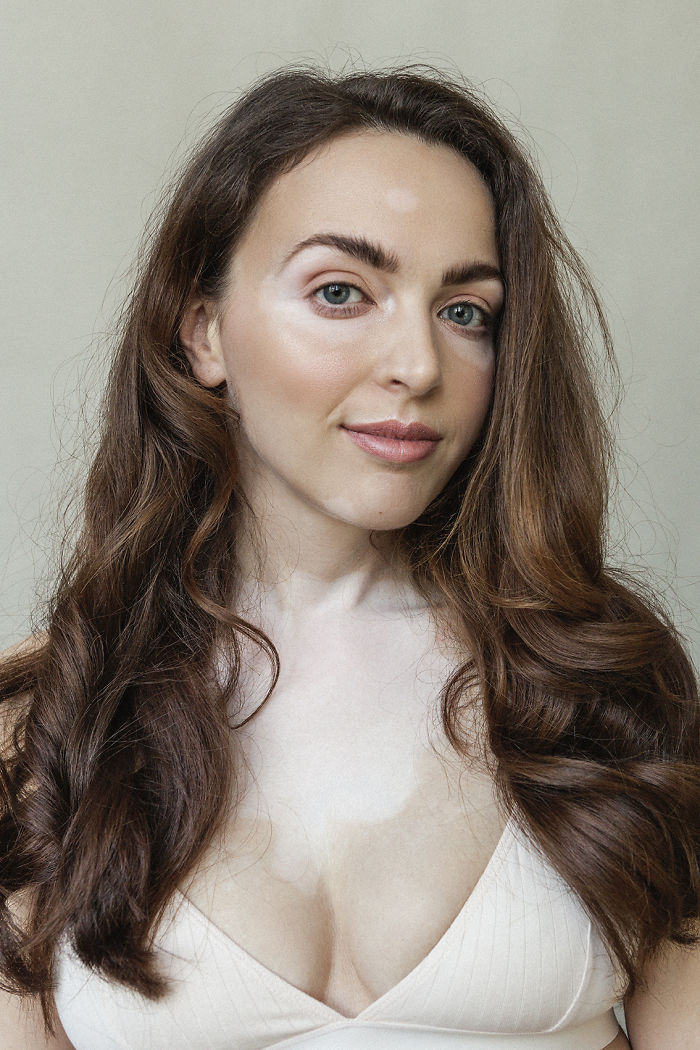 Vitiligo-Beauty-Photography-Elisabeth-Van-Aalderen