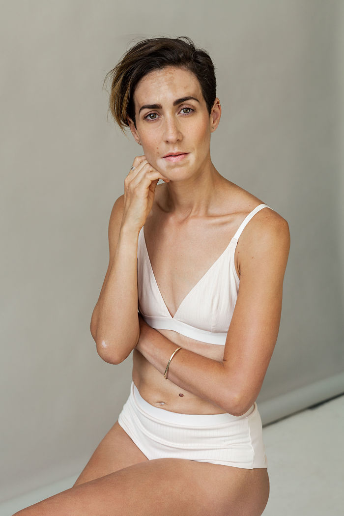 Vitiligo-Beauty-Photography-Elisabeth-Van-Aalderen