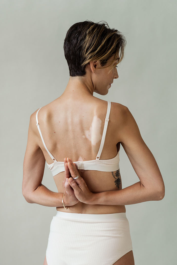 Vitiligo-Beauty-Photography-Elisabeth-Van-Aalderen