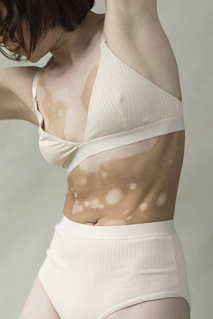 Vitiligo-Beauty-Photography-Elisabeth-Van-Aalderen