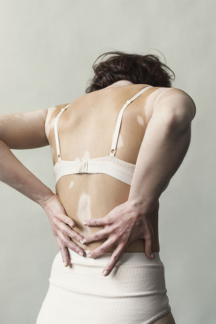Vitiligo-Beauty-Photography-Elisabeth-Van-Aalderen
