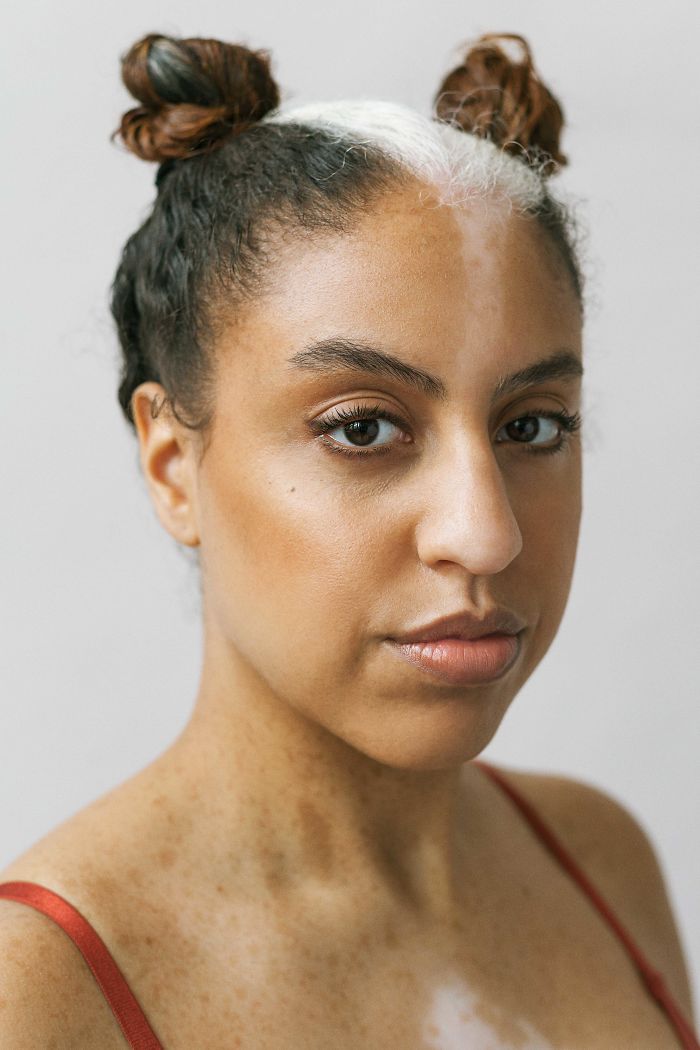 Vitiligo-Beauty-Photography-Elisabeth-Van-Aalderen