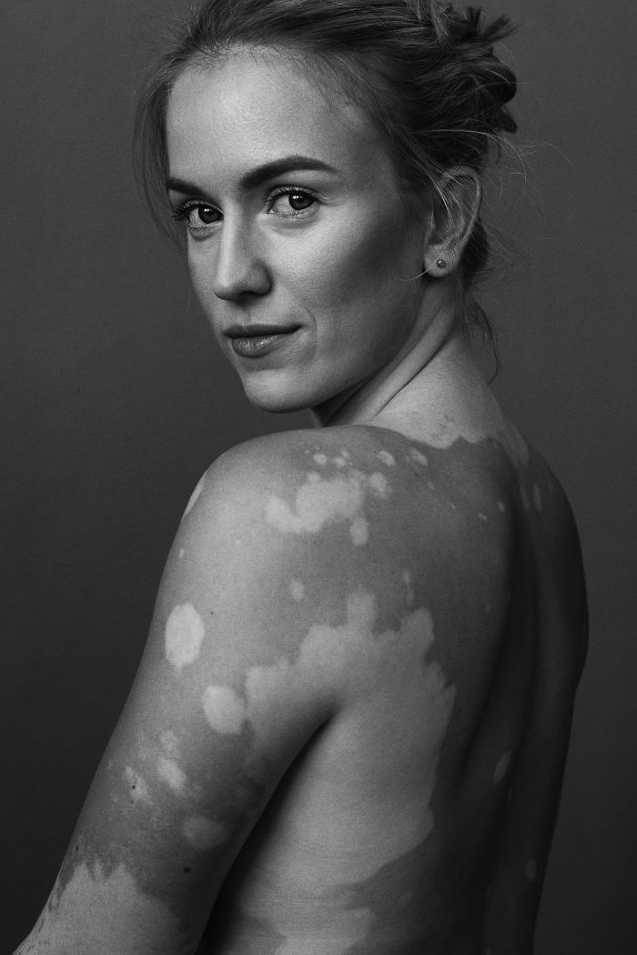 Vitiligo-Beauty-Photography-Elisabeth-Van-Aalderen