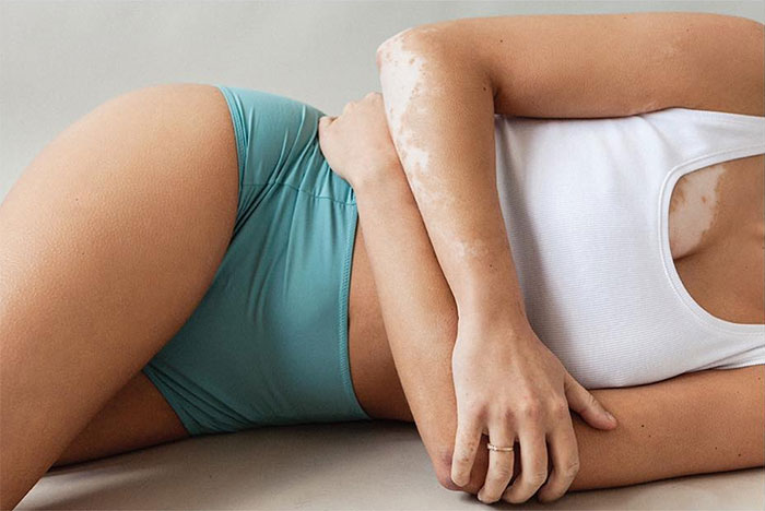 Vitiligo-Beauty-Photography-Elisabeth-Van-Aalderen