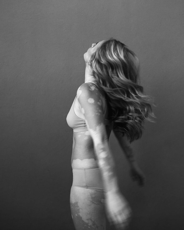 Vitiligo-Beauty-Photography-Elisabeth-Van-Aalderen