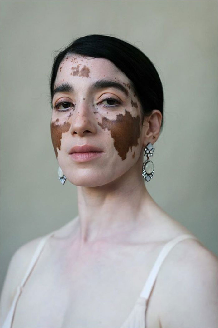 Vitiligo-Beauty-Photography-Elisabeth-Van-Aalderen