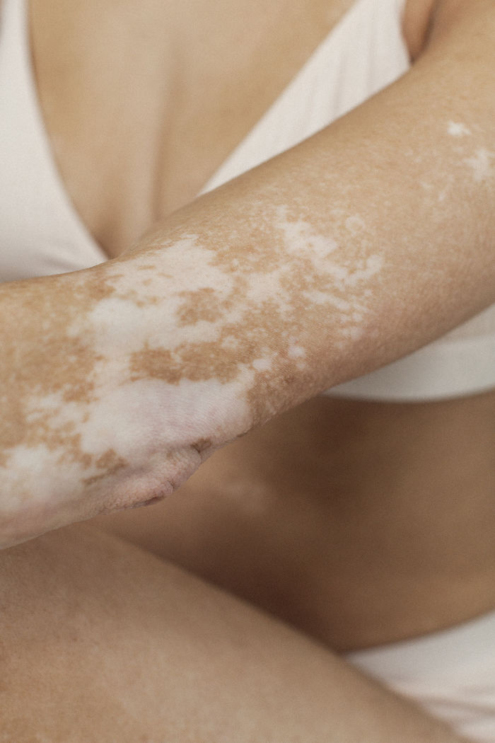 Vitiligo-Beauty-Photography-Elisabeth-Van-Aalderen