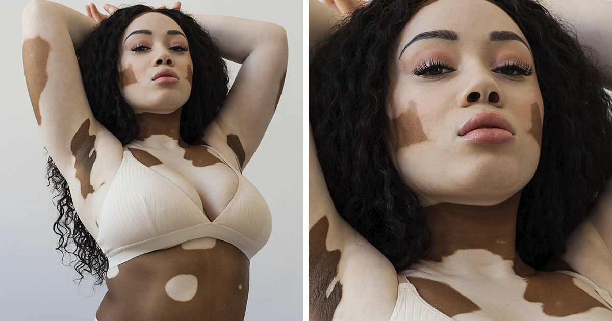 35 Beautiful Women With Vitiligo Shot By A Photographer Who Has The Same Co...