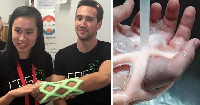 Engineers Create A Breathable And Waterproof Cast To Replace Plaster Ones And Stop The Itching Forever