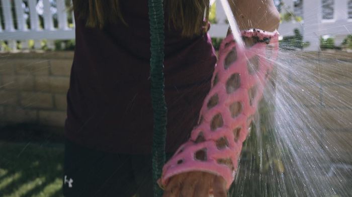 Engineers Create A Breathable And Waterproof Cast To Replace Plaster Ones And Stop The Itching Forever