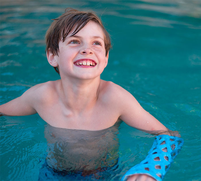 Engineers Create A Breathable And Waterproof Cast To Replace Plaster Ones And Stop The Itching Forever