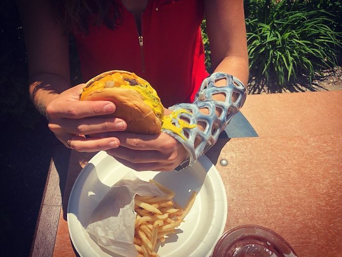 Engineers Create A Breathable And Waterproof Cast To Replace Plaster Ones And Stop The Itching Forever Engineers Create A Breathable And Waterproof Cast To Replace Plaster Ones And Stop The Itching Forever