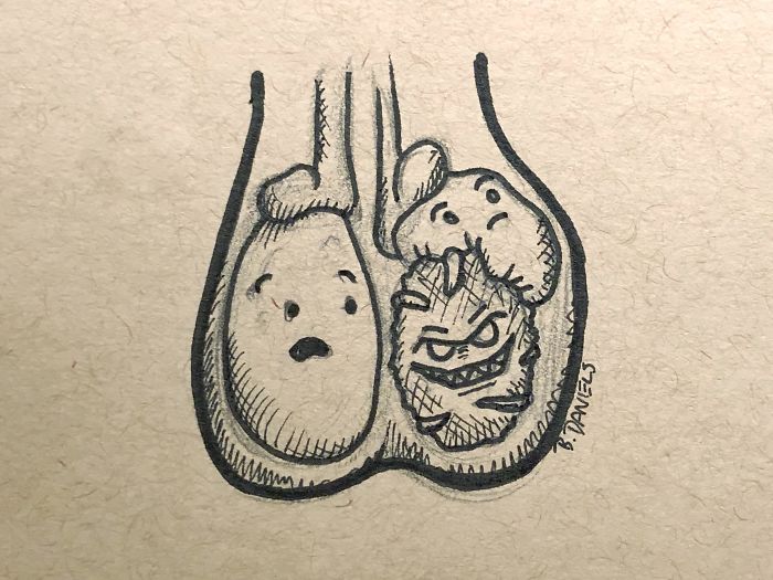 I’m Having My Orchiectomy Today For Testicular Cancer. Here’s My 100% Accurate Representation Of The X-Rays