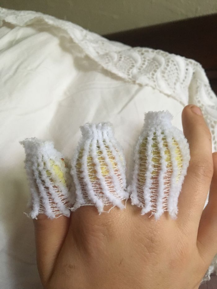 After My Amputations, My Dressings Made My Finger Nubs Look Like Little Cactuses