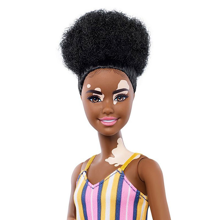 Barbie Celebrates Diversity By Creating Differently-Abled Dolls With Vitiligo And No Hair That Come In 35 Different Skin Tones