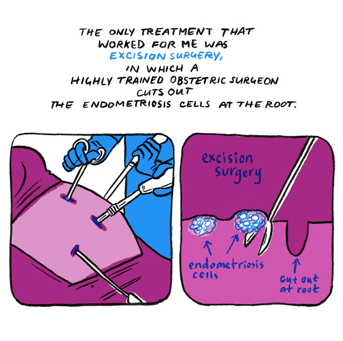 Woman Illustrates The Reality Of Women Who Suffer From Endometriosis Woman Illustrates The Reality Of Women Who Suffer From Endometriosis