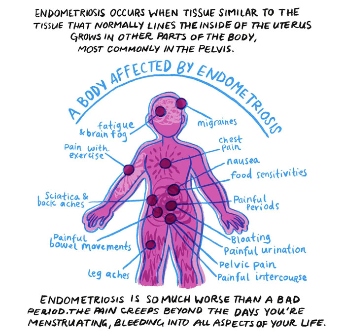 Woman Illustrates The Reality Of Women Who Suffer From Endometriosis Woman Illustrates The Reality Of Women Who Suffer From Endometriosis