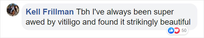 Barbie Celebrates Diversity By Creating Differently-Abled Dolls With Vitiligo And No Hair That Come In 35 Different Skin Tones