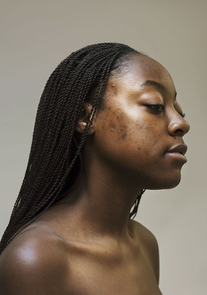 Women-Skin-Problems-Epidermis-Project-Sophie-Harris-Taylor Women-Skin-Problems-Epidermis-Project-Sophie-Harris-Taylor