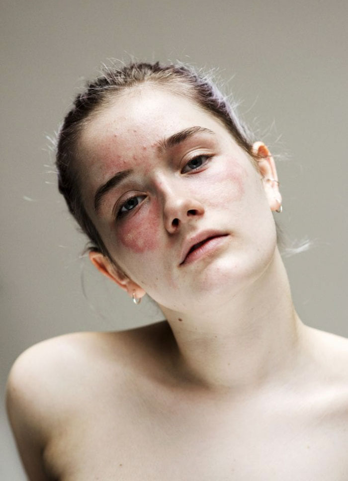 Women-Skin-Problems-Epidermis-Project-Sophie-Harris-Taylor Women-Skin-Problems-Epidermis-Project-Sophie-Harris-Taylor