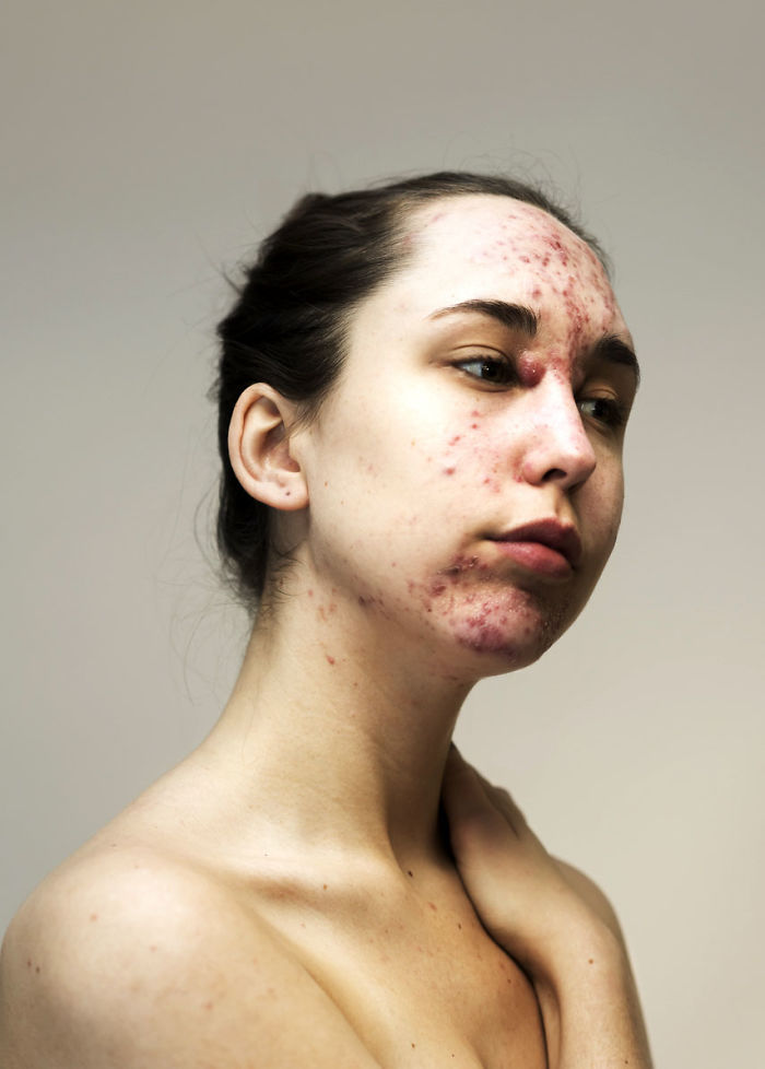 Women-Skin-Problems-Epidermis-Project-Sophie-Harris-Taylor