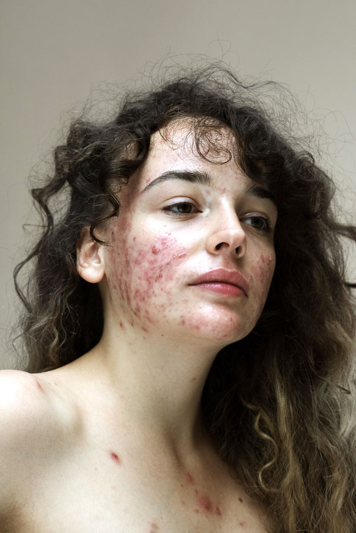 Women-Skin-Problems-Epidermis-Project-Sophie-Harris-Taylor