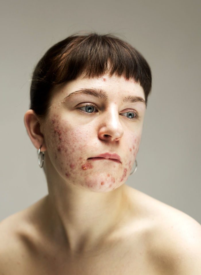 Women-Skin-Problems-Epidermis-Project-Sophie-Harris-Taylor Women-Skin-Problems-Epidermis-Project-Sophie-Harris-Taylor
