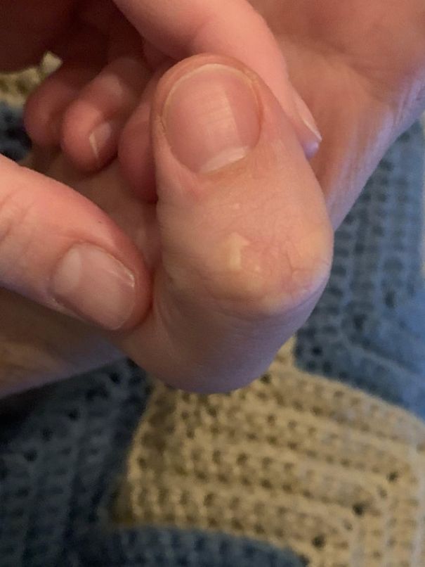 "My roommate's arrow scar"