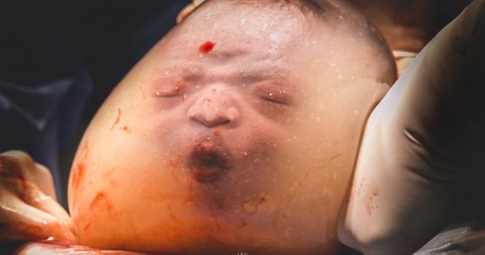 Newborn baby inside the amniotic sac captured in a stunning birth photo from the 2020 birth photography competition.