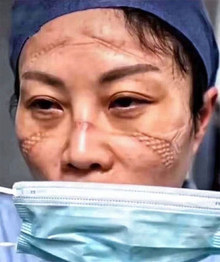 Chinese Nurses Share Pictures Of How Their Faces Look After Countless Hours Fighting The Coronavirus Chinese Nurses Share Pictures Of How Their Faces Look After Countless Hours Fighting The Coronavirus