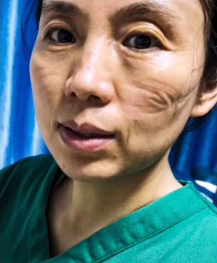 Chinese Nurses Share Pictures Of How Their Faces Look After Countless Hours Fighting The Coronavirus Chinese Nurses Share Pictures Of How Their Faces Look After Countless Hours Fighting The Coronavirus